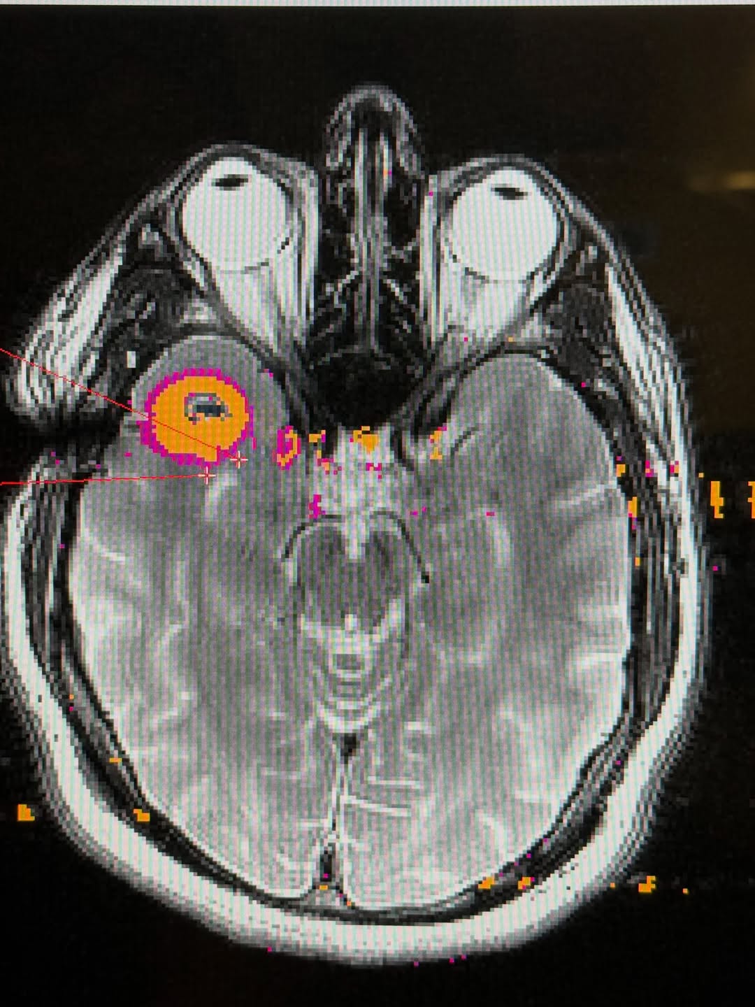 MRI color map from Owen's LITT laser ablation procedure